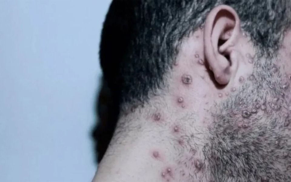 La OMS le recomendó a los gays reducir las parejas sexuales ante el brote de viruela del mono