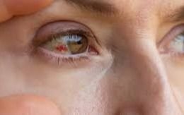 ¿Cuáles son los 8 signos del virus que puede provocar la muerte a través de un sangrado ocular?