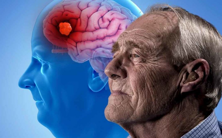 Estados Unidos aprobó el uso de un fármaco que retrasa moderadamente el Alzheimer