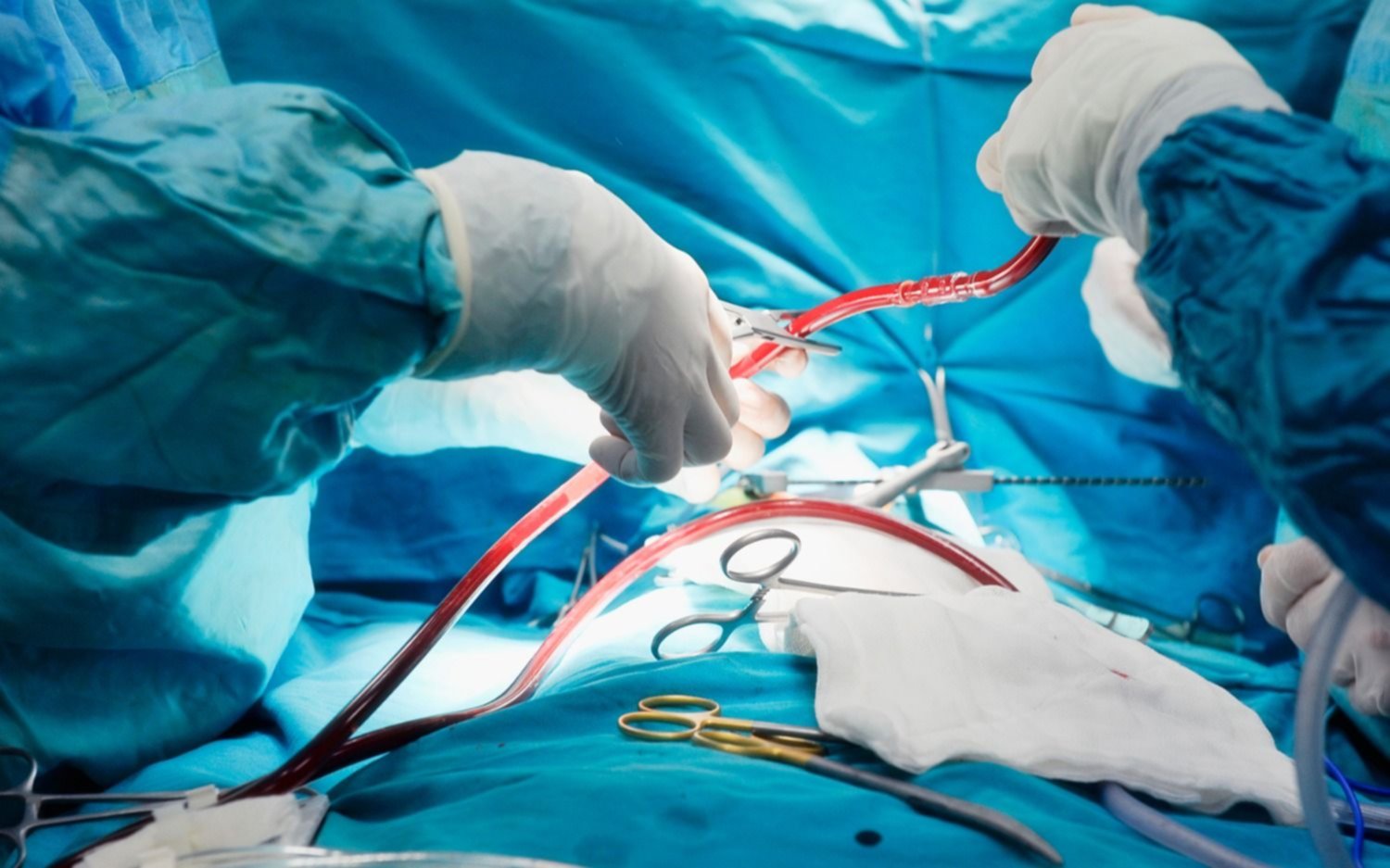 ¿Por qué durante dos días los cardiólogos no colocarán stents ni harán angioplastias?