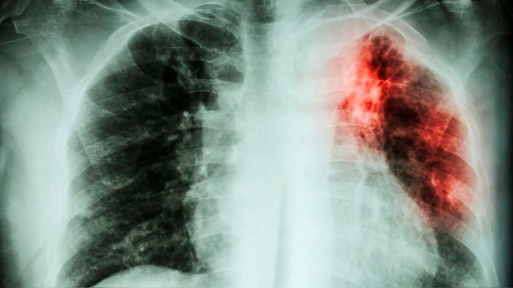 Alarma sanitaria: la tuberculosis aumentó 38% en el país