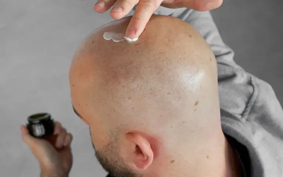 La esperanza científica de los pelados: hallaron la molécula que impulsa el crecimiento del pelo