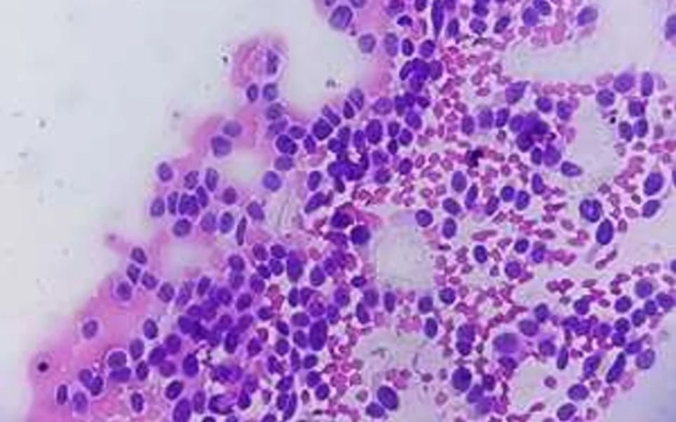 Alertan sobre el linfoma de células del manto, un cáncer poco frecuente y de difícil diagnóstico