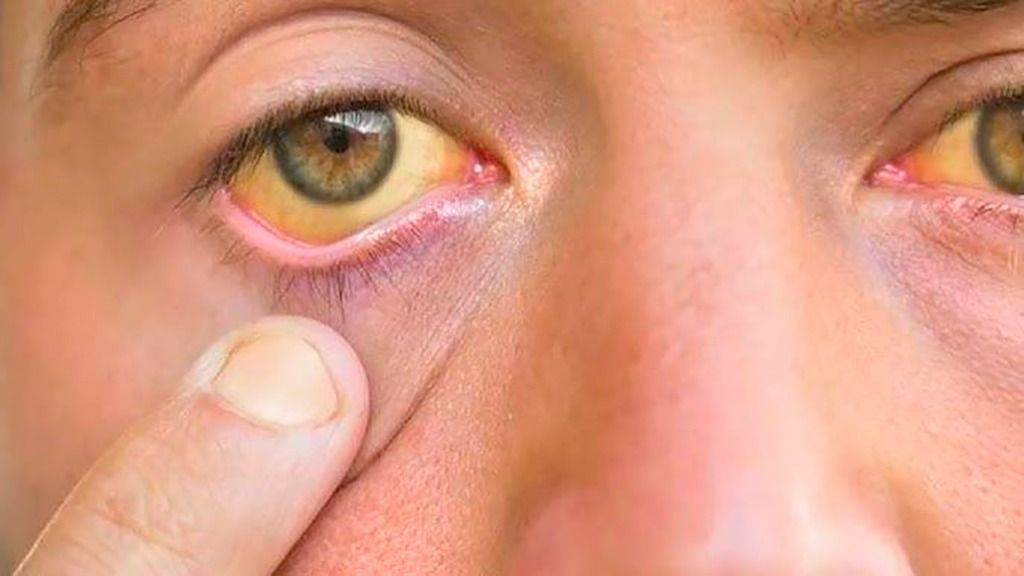 Atención con la hepatitis: avanza su tipo más peligroso en el país