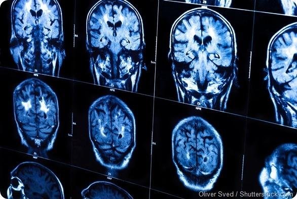 Estudios indican que los tics nerviosos pueden ser síntomas de Tourette