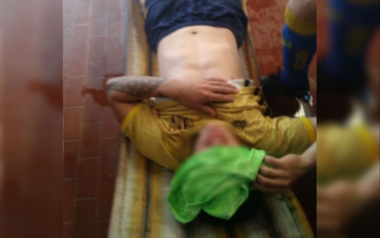 Preocupación en la Liga Amateur Platense: atacaron a un jugador con agua caliente