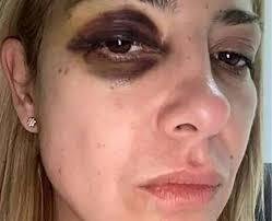 Revelan que la exprimera dama habría sido golpeada durante su embarazo