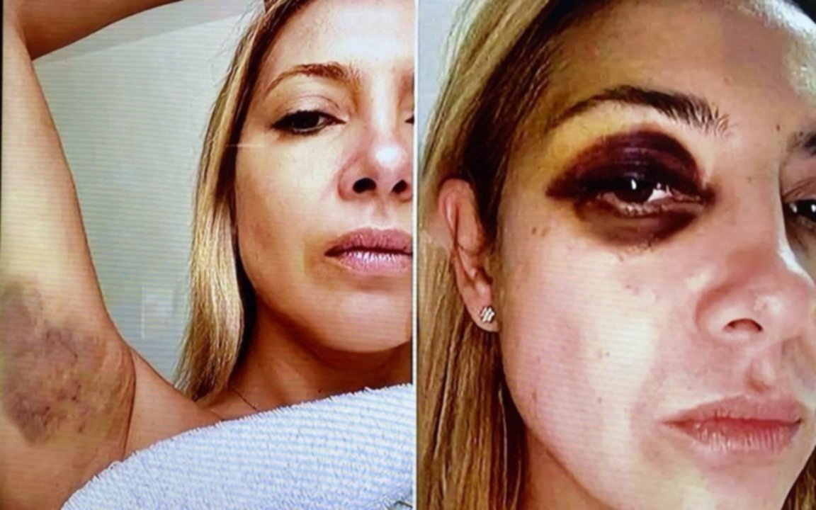 Alberto Fernández desmintió los hechos de violencia física a Fabiola Yañez y señaló que fueron tras un tratamiento estético