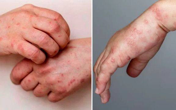Viruela símica y herpes zóster: ¿cuáles son las diferencias y por qué las confunden?