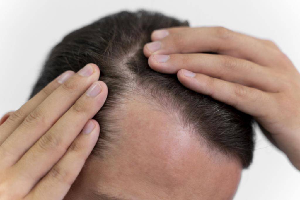 Se me cae el pelo: cuando el estrés deja una huella en la cabeza