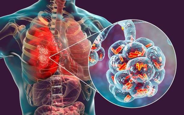 Klebsiella pneumoniae y Ralstonia pickettii, las bacterias del fentanilo contaminado: qué provocan