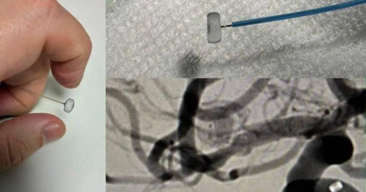 Logro médico en La Plata: Intervención inédita para tratar un aneurisma cerebral en el sistema público