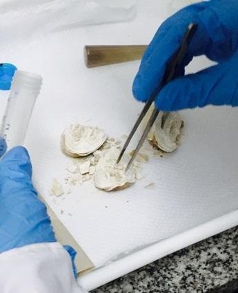Un proyecto platense sobre cálculos renales atraviesa fronteras