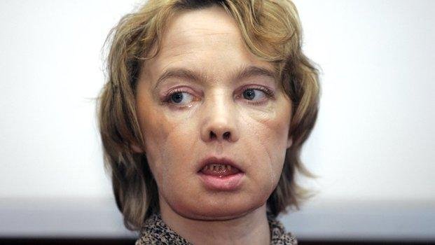 Falleció paciente que recibió el primer trasplante de rostro en el mundo
