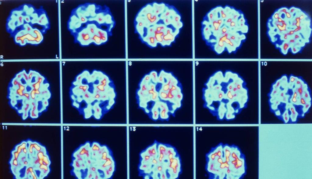 Los retos en la búsqueda de un tratamiento efectivo contra la enfermedad de Alzheimer