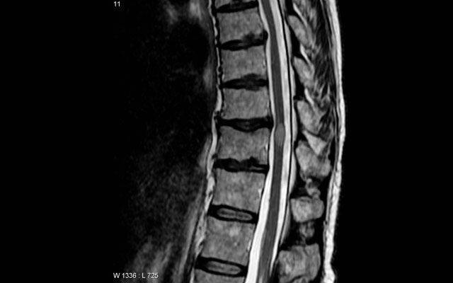 Mielitis transversa, la enfermedad por la que pausaron los ensayos de la vacuna de Oxford contra el COVID-19