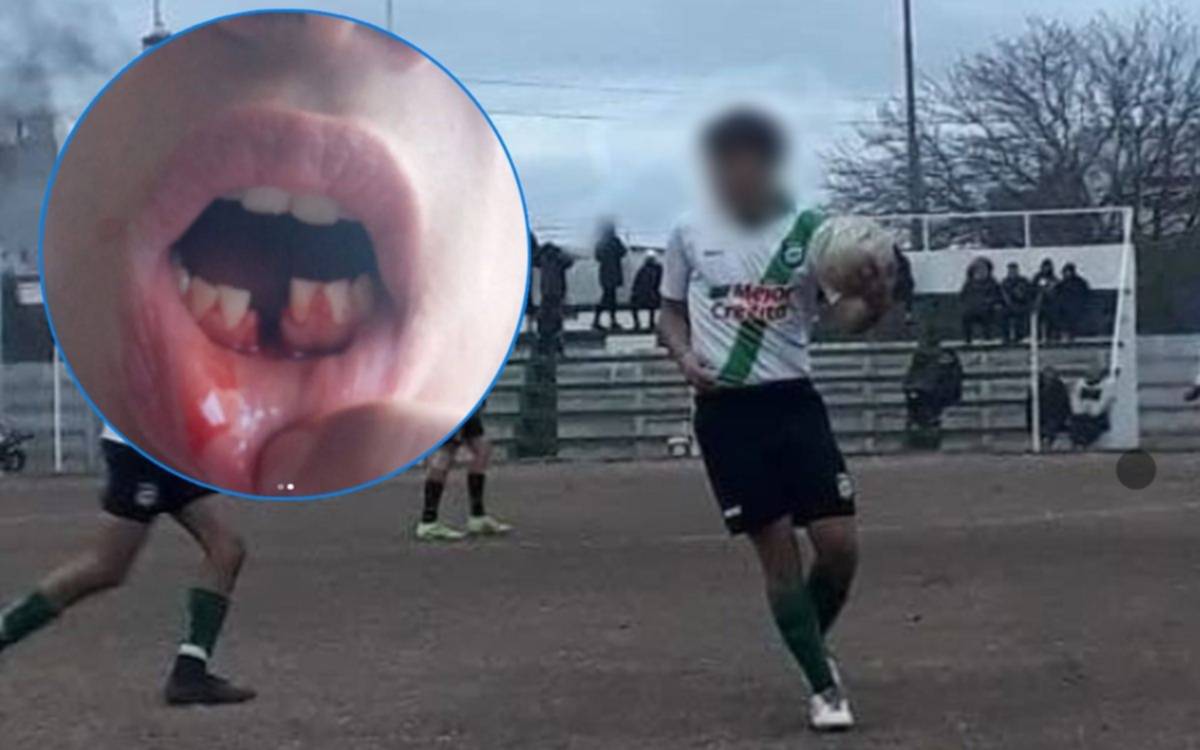 Brutal agresión a un juvenil de CRISFA en un partido de la Liga Amateur Platense: será operado