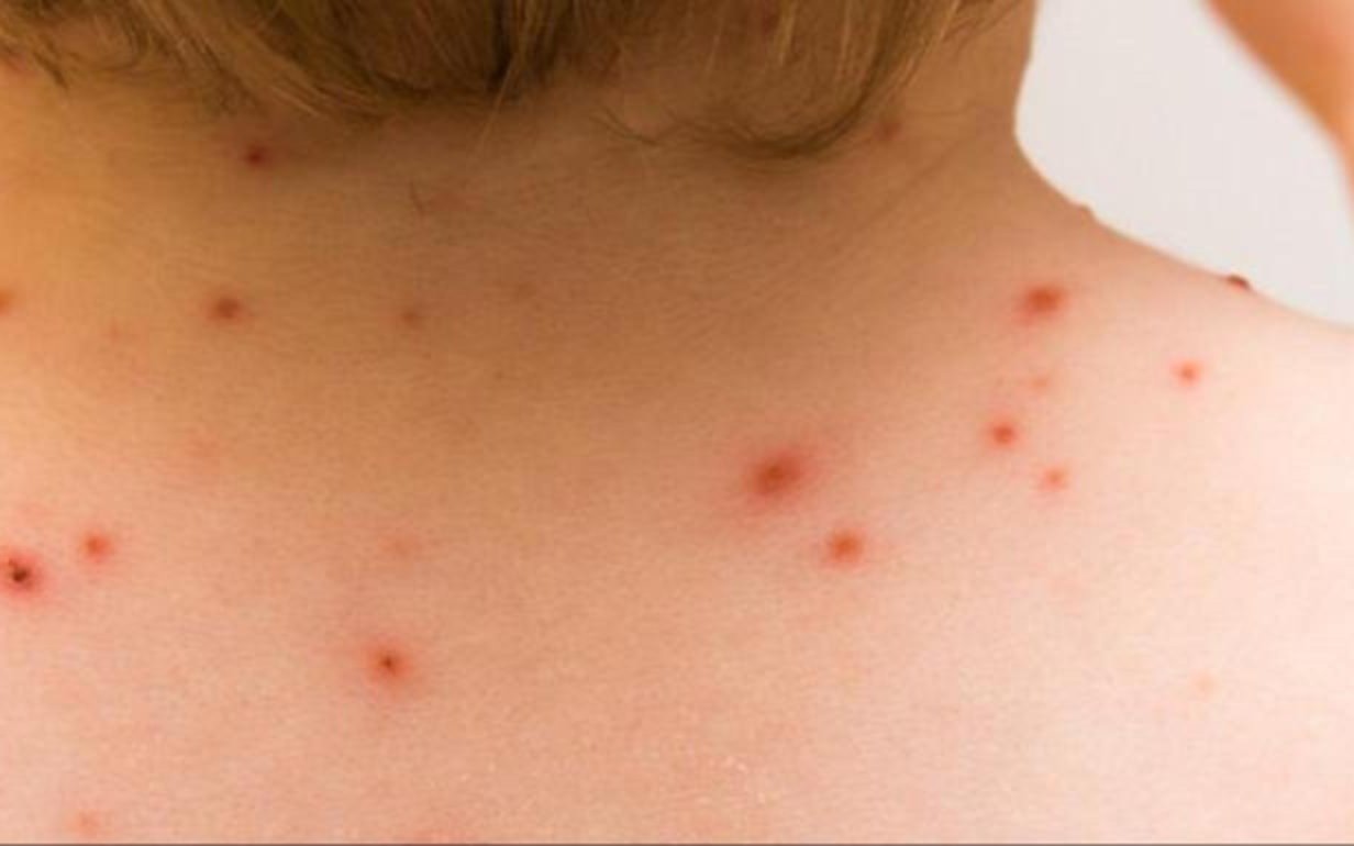 Viruela del Mono: Estados Unidos comienza ensayos clínicos para una vacuna