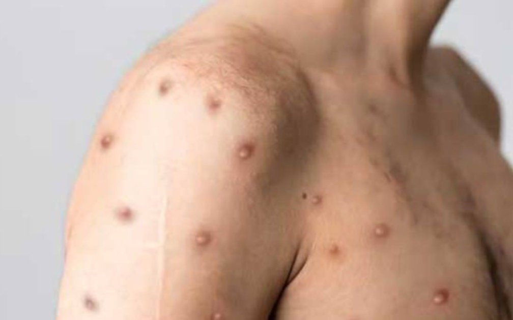 Alerta por la viruela del mono: se confirmaron 326 nuevos casos y sigue creciendo los contagios