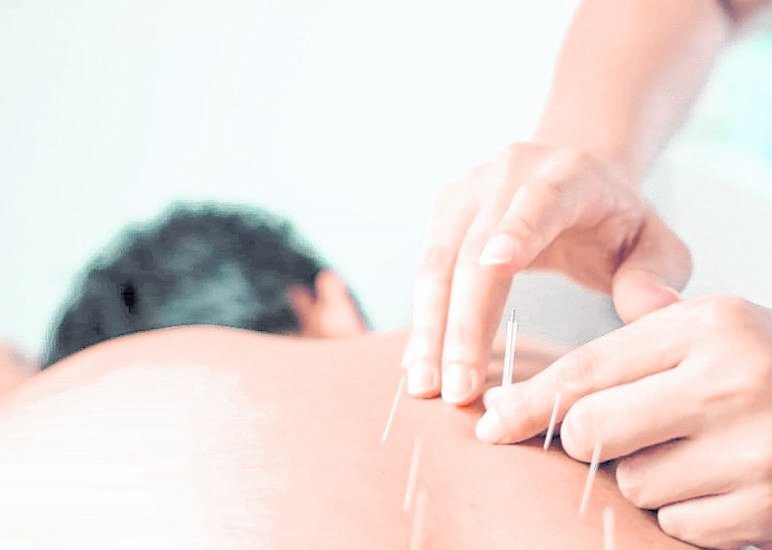 Crece el uso de la acupuntura para atacar el dolor