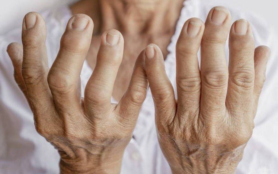 Artritis reumatoidea: el aporte de un experto de La Plata y la necesidad de un diagnóstico temprano