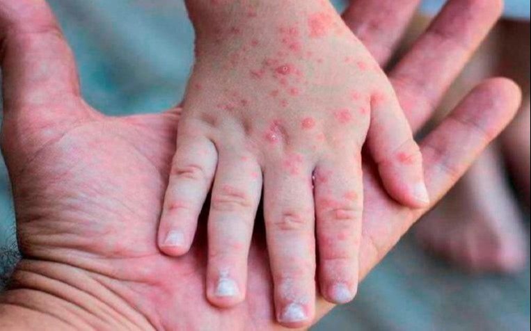 Viruela del mono: confirmaron 10 nuevos casos en Argentina