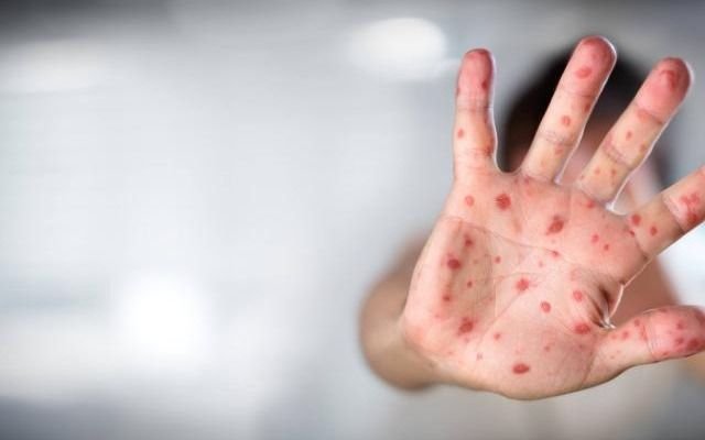 Viruela del Mono: la OMS aprobó la primera vacuna global