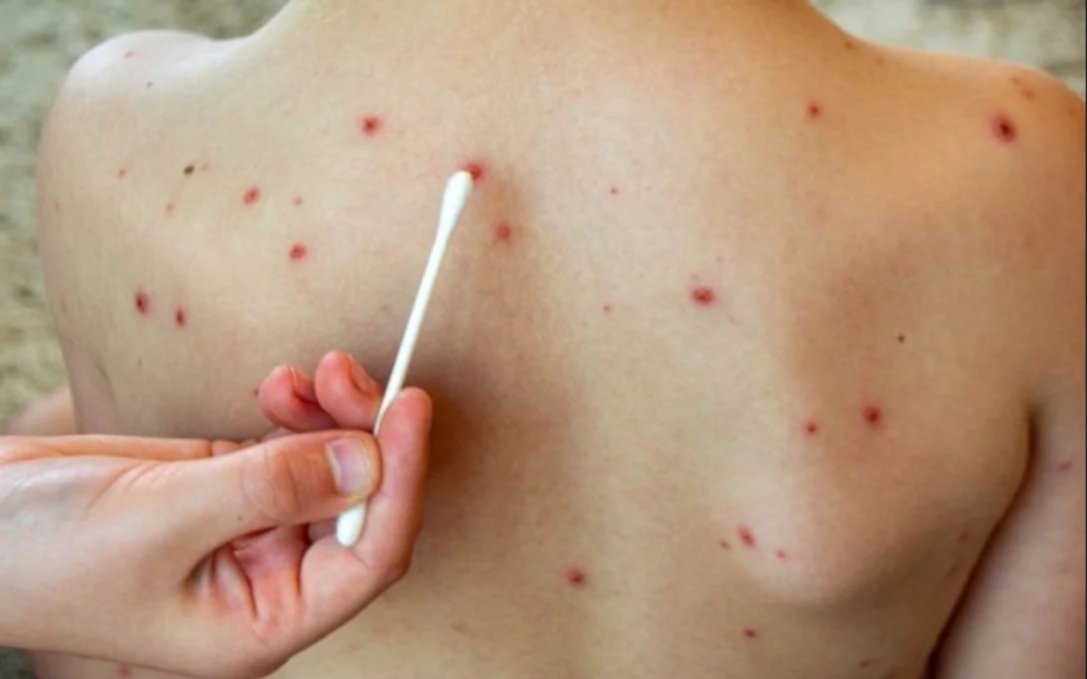 Viruela del mono: detectaron diez nuevos casos en Argentina