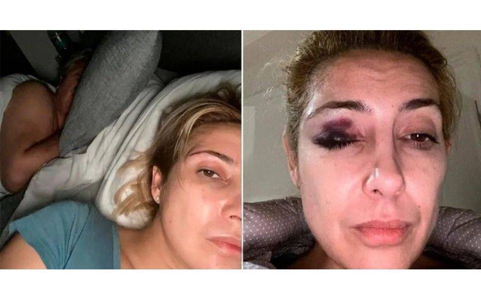 Revelan nuevas fotos de Fabiola Yañez con moretones en la cara y Alberto Fernández a su lado