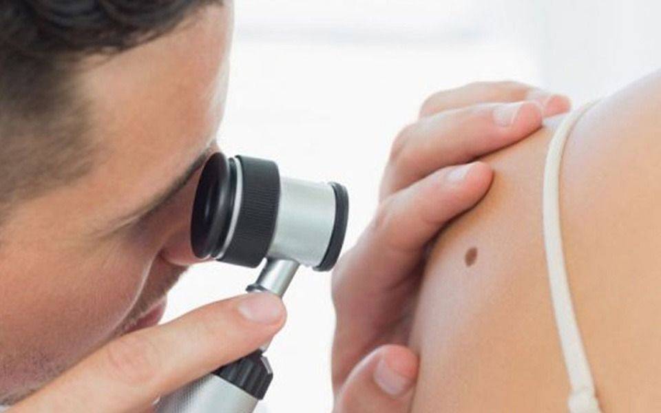  Control de lunares: una medida fundamental para la prevención del cáncer de piel