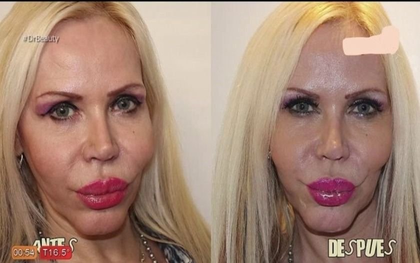 "La Pradón" volvió a la TV: se hizo un tratamiento estético de rostro y partes íntimas