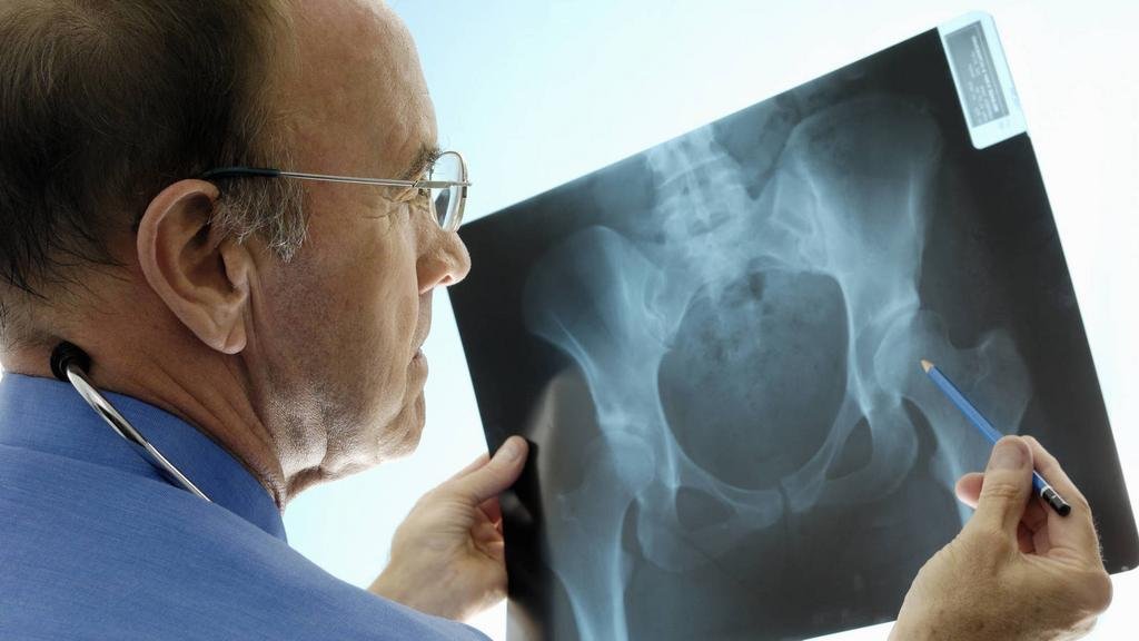 La pandemia incrementó la fragilidad por osteoporosis