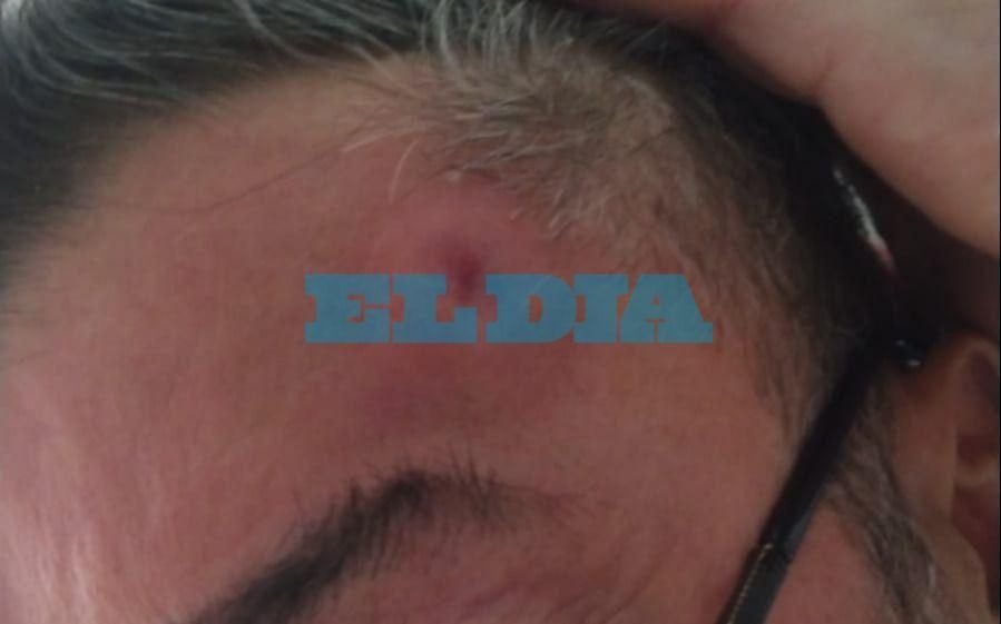 La angustia de un platense que pasaba por una protesta y recibió un piedrazo en la frente
