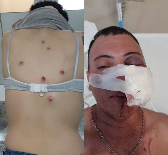 La represión, en carne propia: dramático relato de un hincha de Gimnasia que puede perder un ojo