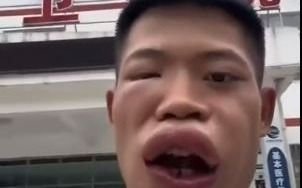 VIDEO. De no creer: un joven influencer de China, se comió una avispa y terminó con su cara desfigurada