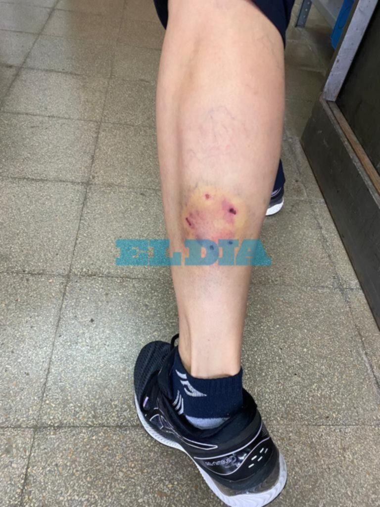 Iba en bici por el Bosque, la atacó un perro y así le quedó la pierna