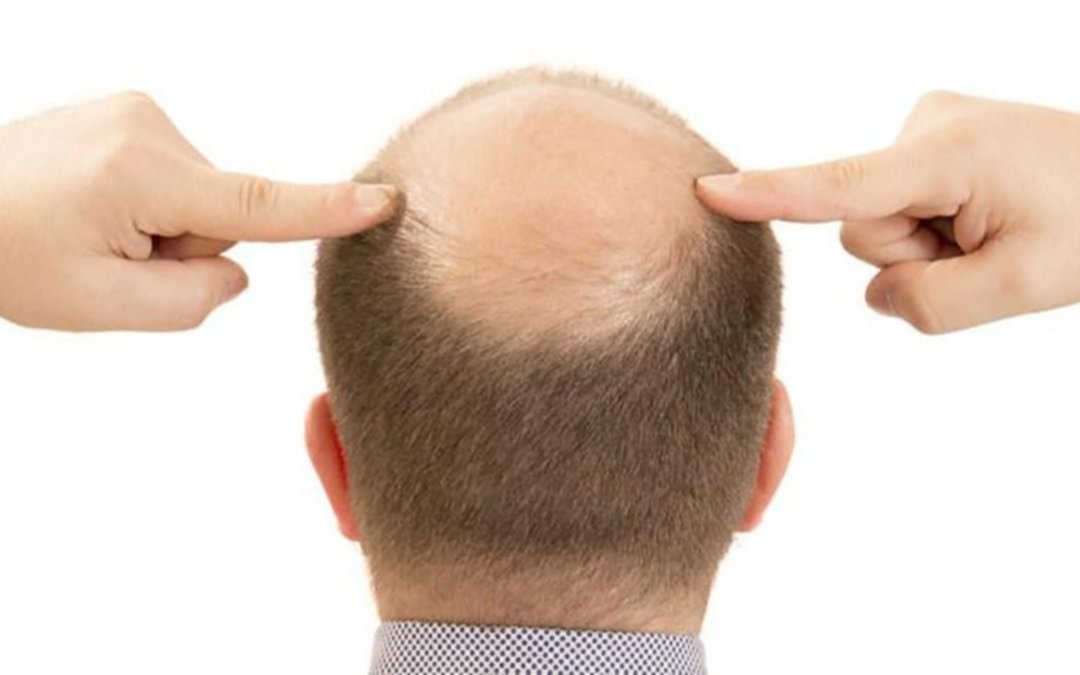 ¿Se viene el fin de la calvicie? Lograron cultivar una fuente inagotable de pelo