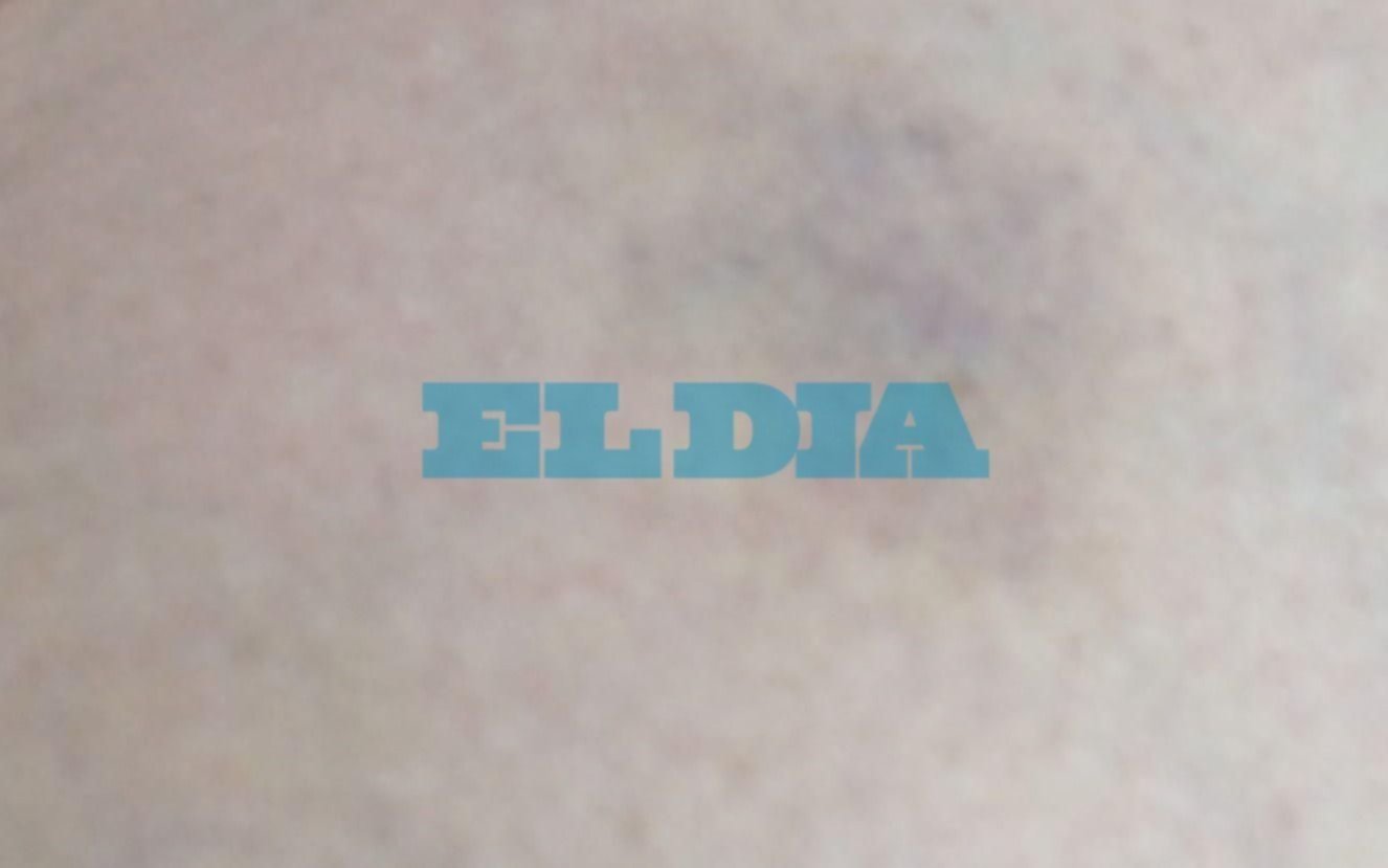 Una platense se cayó en pleno Barrio Norte por una tapa de desagüe rota y sufrió hematomas
