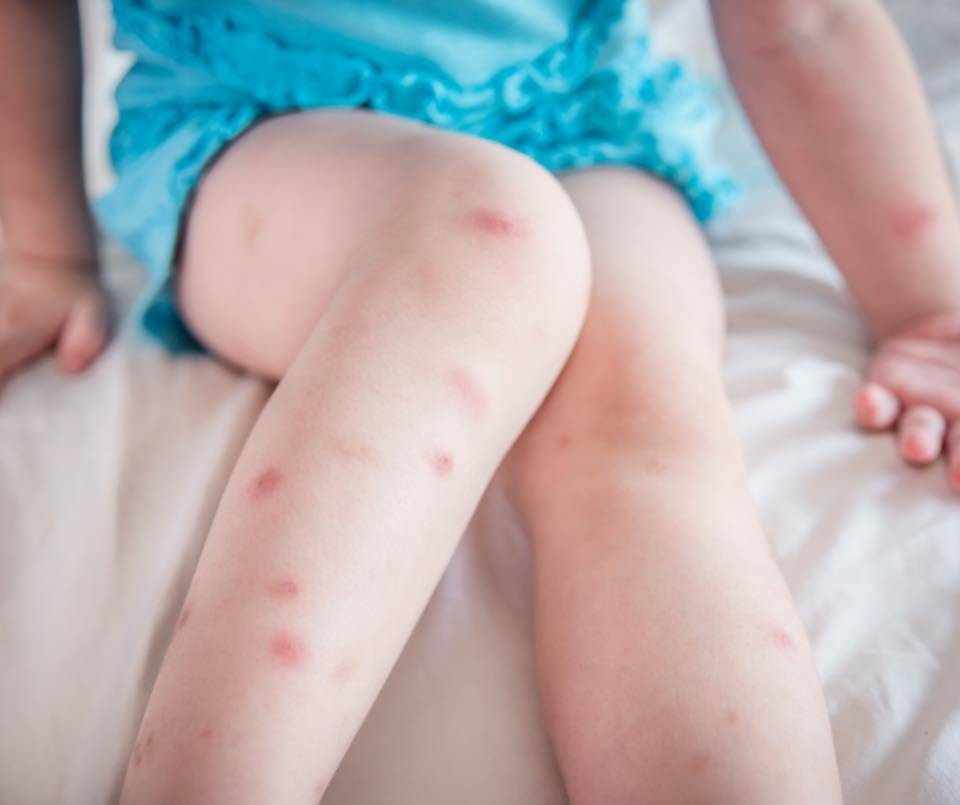 Fiebre de Oropouche: alertan que ya circula en el país