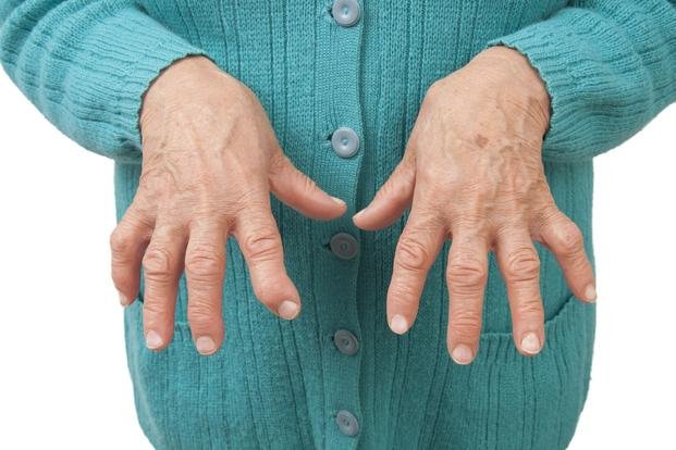Artritis reumatoidea y la importancia de contar con un diagnóstico precoz