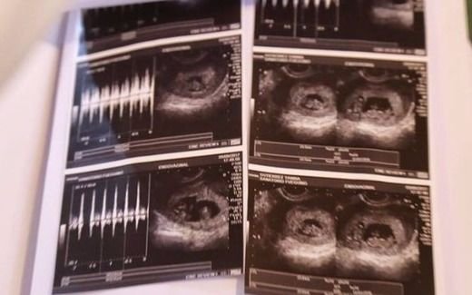 Fallecieron los cuatro bebés de una mujer que iba a ser madre de gemelos y mellizos