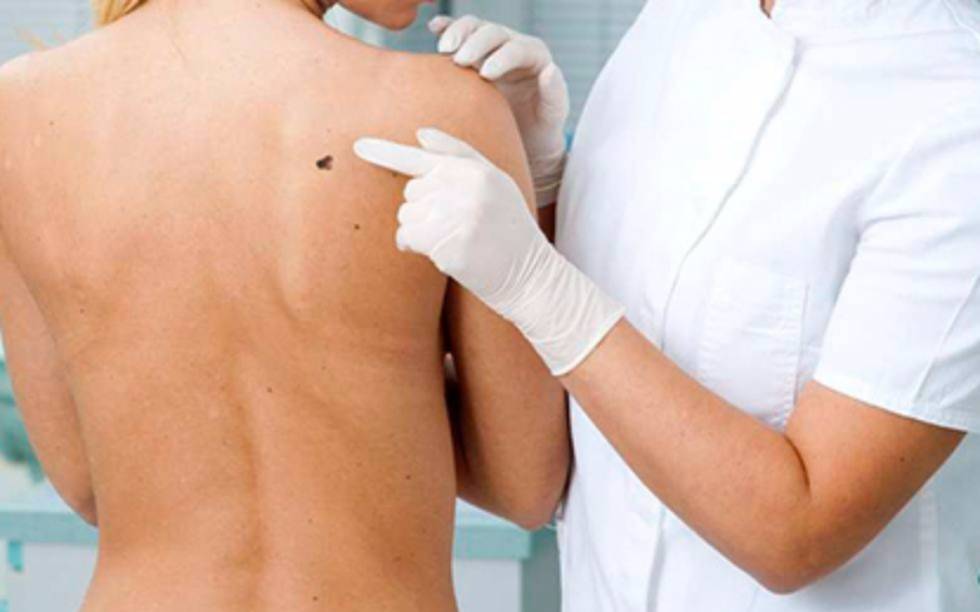 Comenzó una nueva campaña de prevención del cáncer de piel