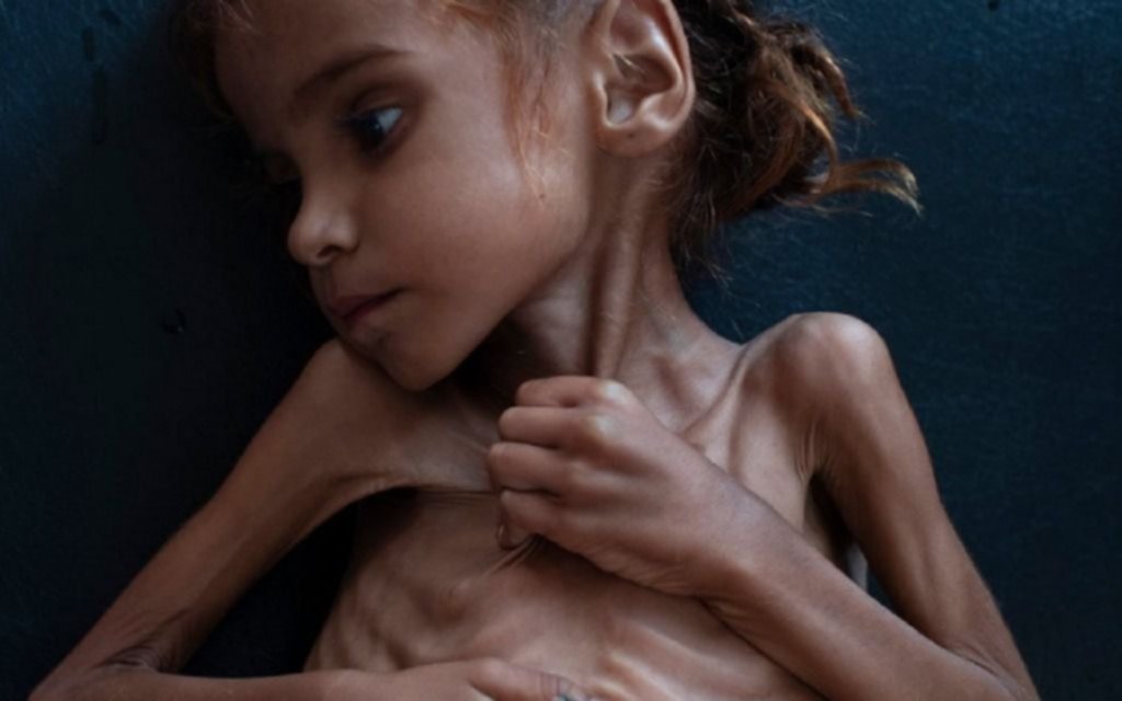 Murió Amal Hussain, la niña símbolo de la hambruna y la guerra en Yemen