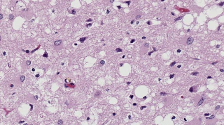 Una enfermedad priónica que destruye el cerebro se está volviendo más común
