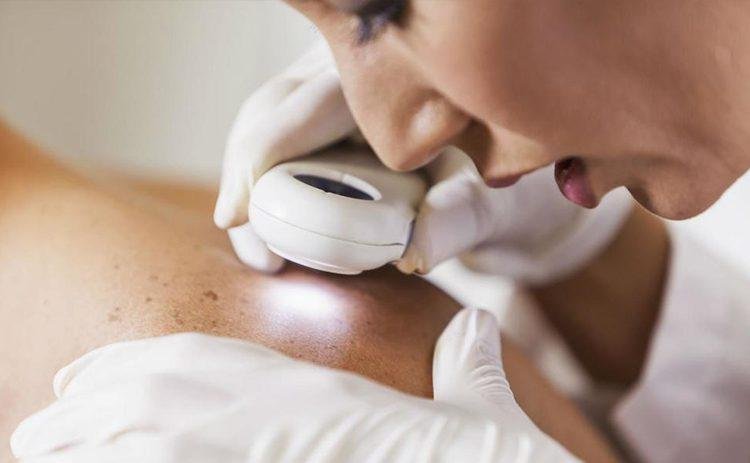 Por temor al COVID disminuyó la detección del cáncer de piel
