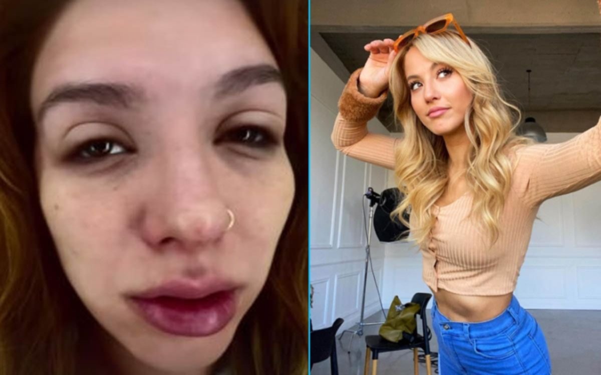 Con la cara deformada: Flor Vigna mostró su rostro inflamado y alertó a sus seguidores