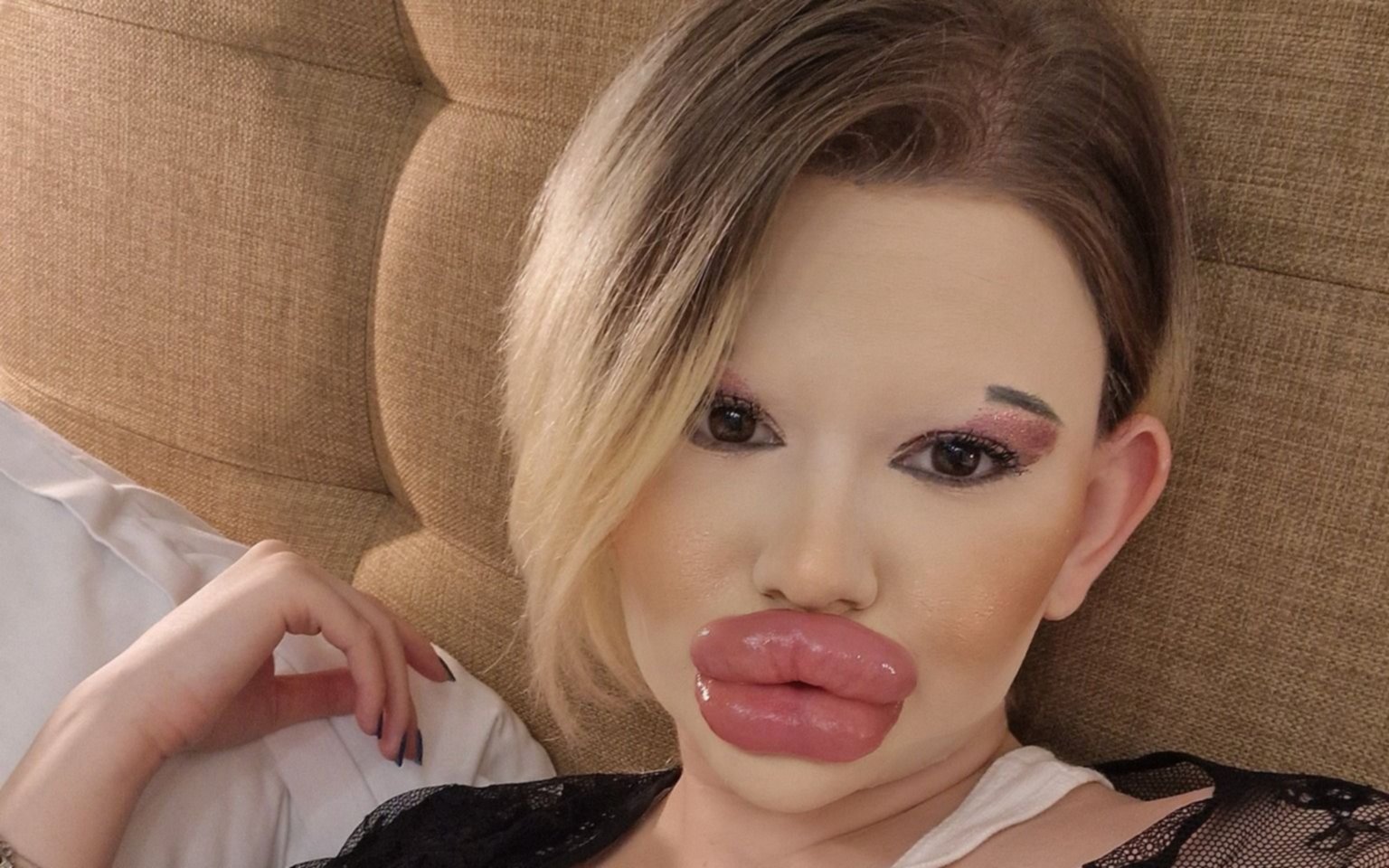 Una joven búlgara, obsesionada con tener "los labios más grandes del mundo": lleva casi 32 inyecciones