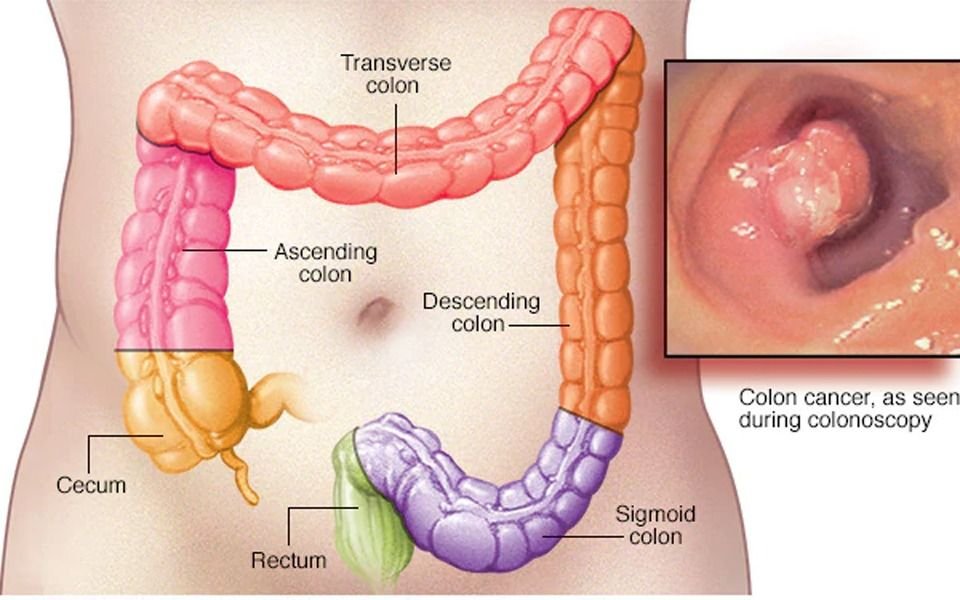 Cáncer de colon: descubren las células responsables de la recaída en pacientes