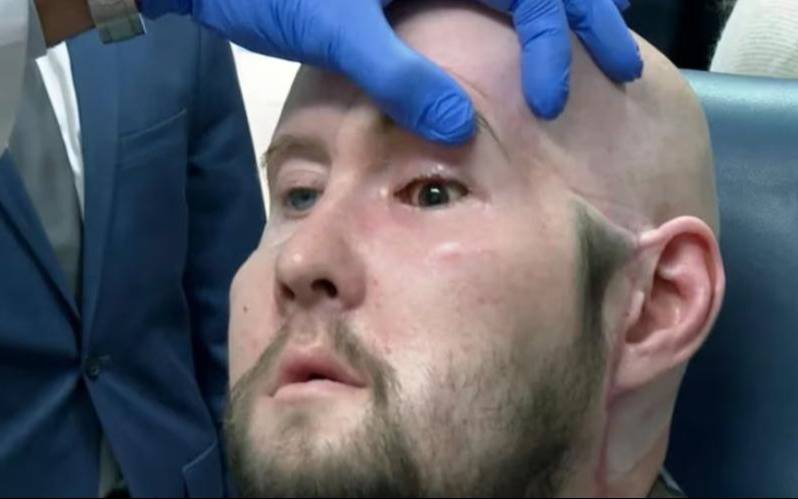 Estados Unidos: se realizó el primer trasplante de ojo completo del mundo