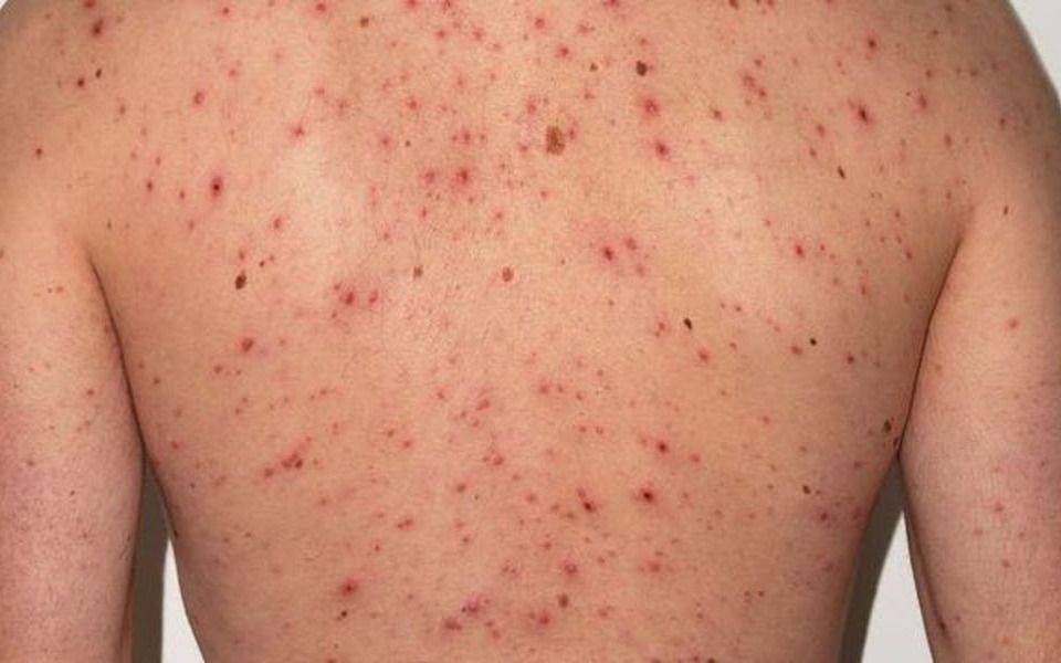 Canadá no logró contener el sarampión y las autoridades piden guardia alta a nivel continental